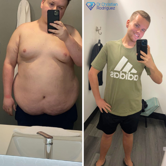 Christian W Before and After Duodenal Switch