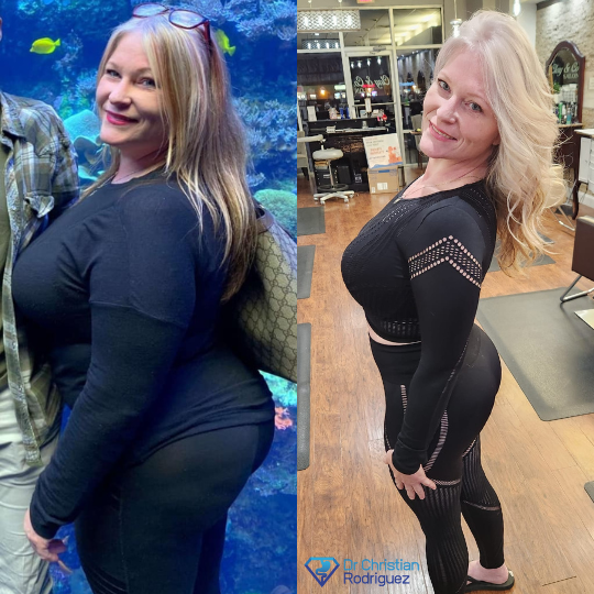 D Ann Before and After Gastric Sleeve Surgery