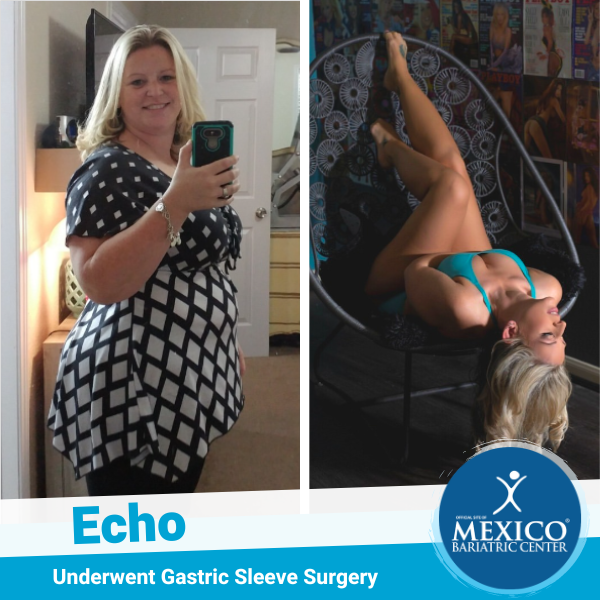 Echo Before and After Sleeve Surgery