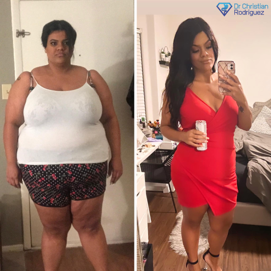 Tasha Before and After RNY Gastric Bypass Surgery