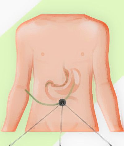 Single Incision Gastric Sleeve Diagram