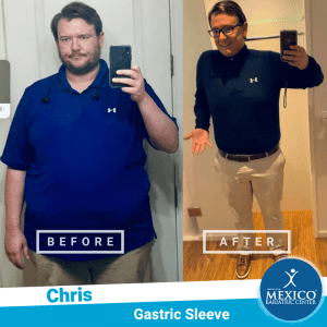 Before and After - Chris S - Gastric Sleeve - 2020 - Mexico Bariatric Center