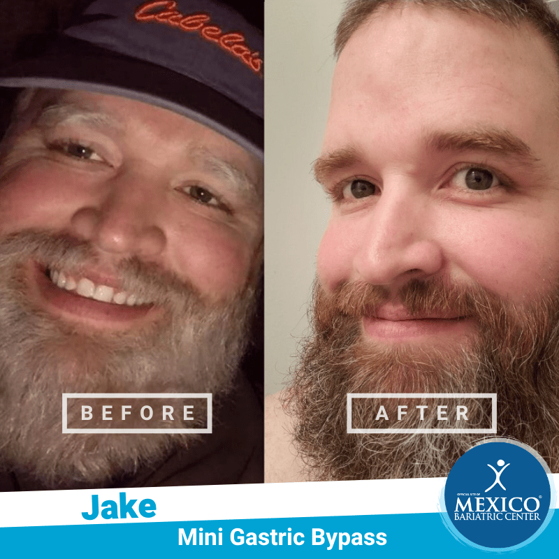 Before and After Jake - Mini Gastric Bypass - Mexico Bariatric Center - Dr Rodriguez