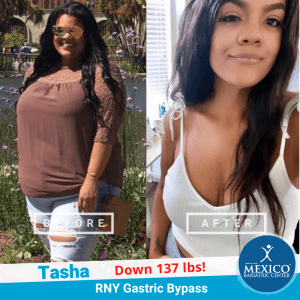 Before and After Tasha - RNY Gastric Bypass - Mexico Bariatric Center - Dr Rodriguez