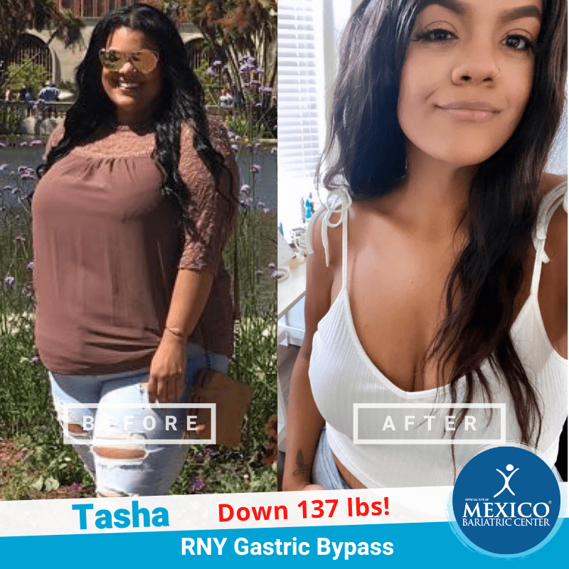 gastric bypass before and after black women