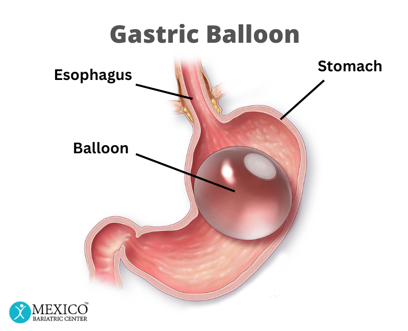 Gastric Balloon