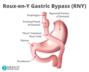 Roux-en-Y Gastric Bypass (RNY)