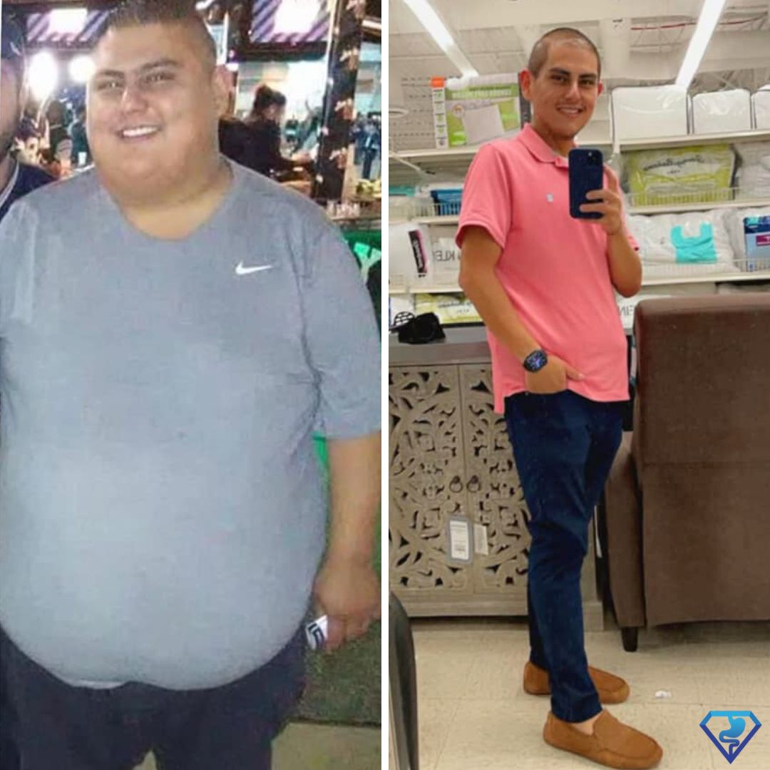 Bobby A Before and After Gastric Bypass -Dr. Christian Rodriguez