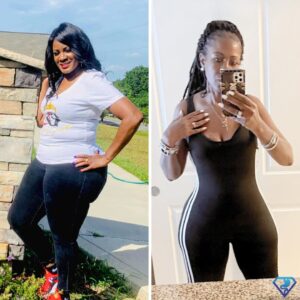 Stefani Before and After Gastric Sleeve -Dr. Christian Rodriguez
