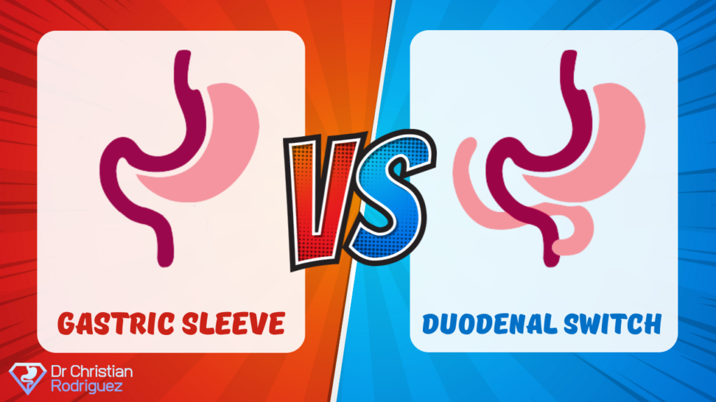 Gastric Sleeve vs Duodenal Switch Surgery