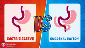 Gastric Sleeve vs Duodenal Switch Surgery